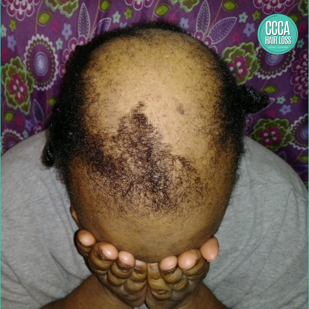 Ccca alopecia deals